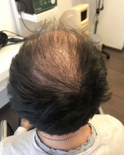 trapianto-capelli-tuchia-qualità