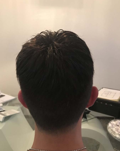 trapianto-capelli-turchia-quanto-costa